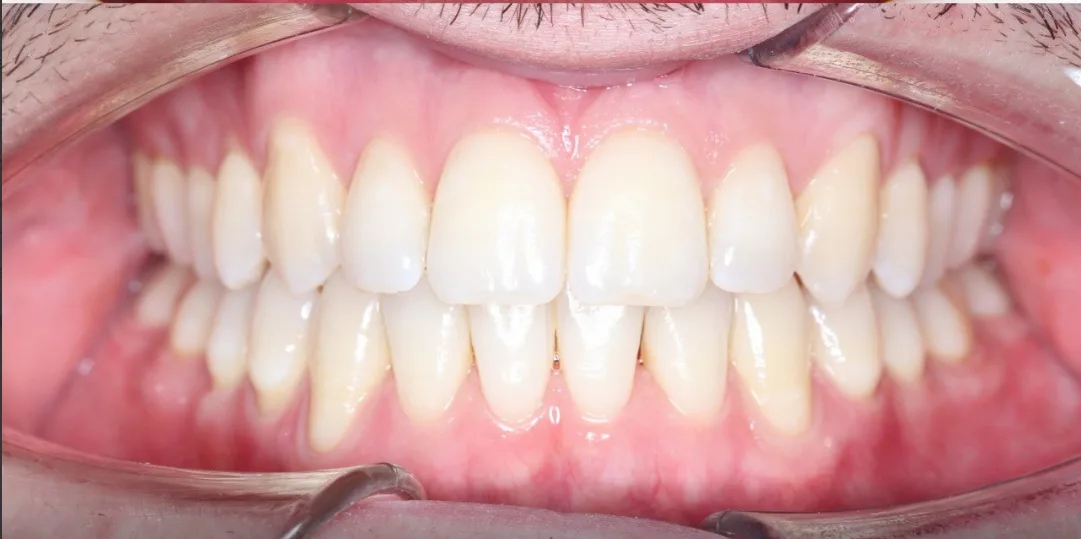 Зубы после лечения — результат стоматологии Dental Centre в Красногорске