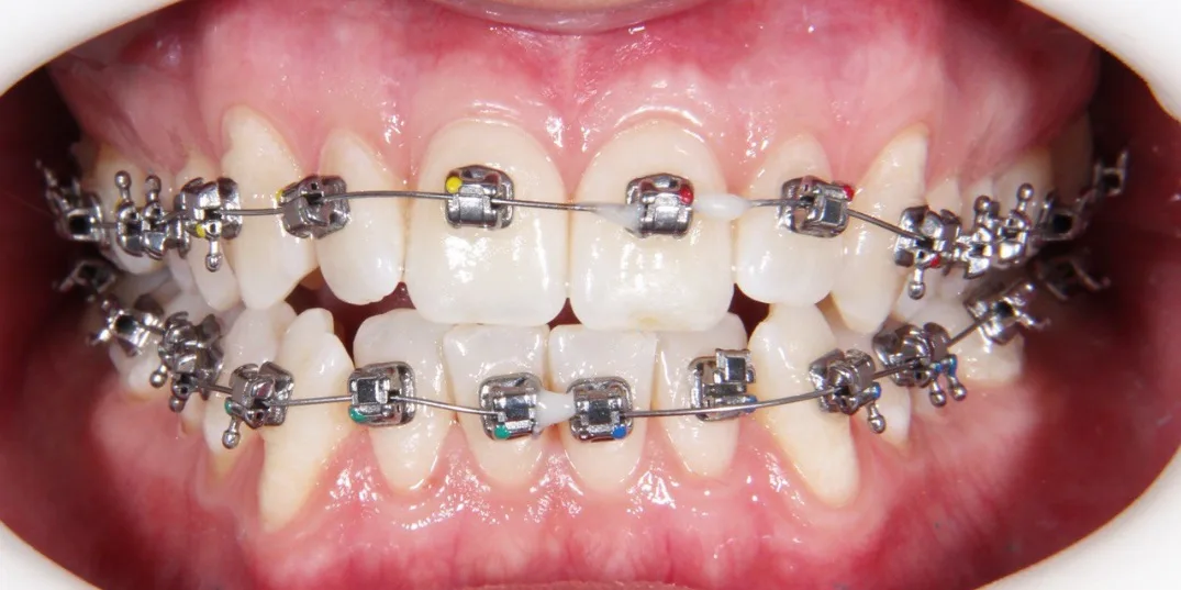 Зубы до лечения — до и после, стоматология Dental Centre Красногорск