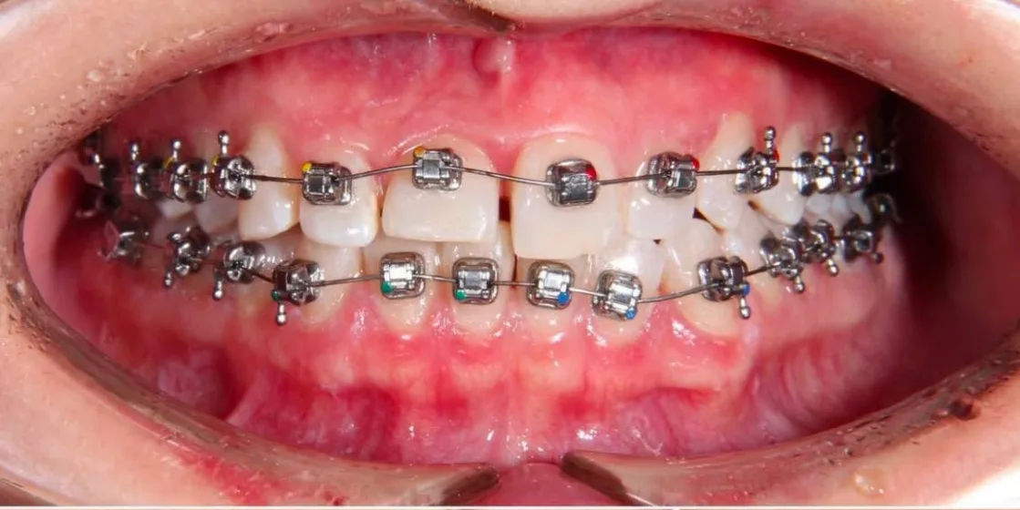 Улыбка до лечения — пример работы стоматологов Dental Centre