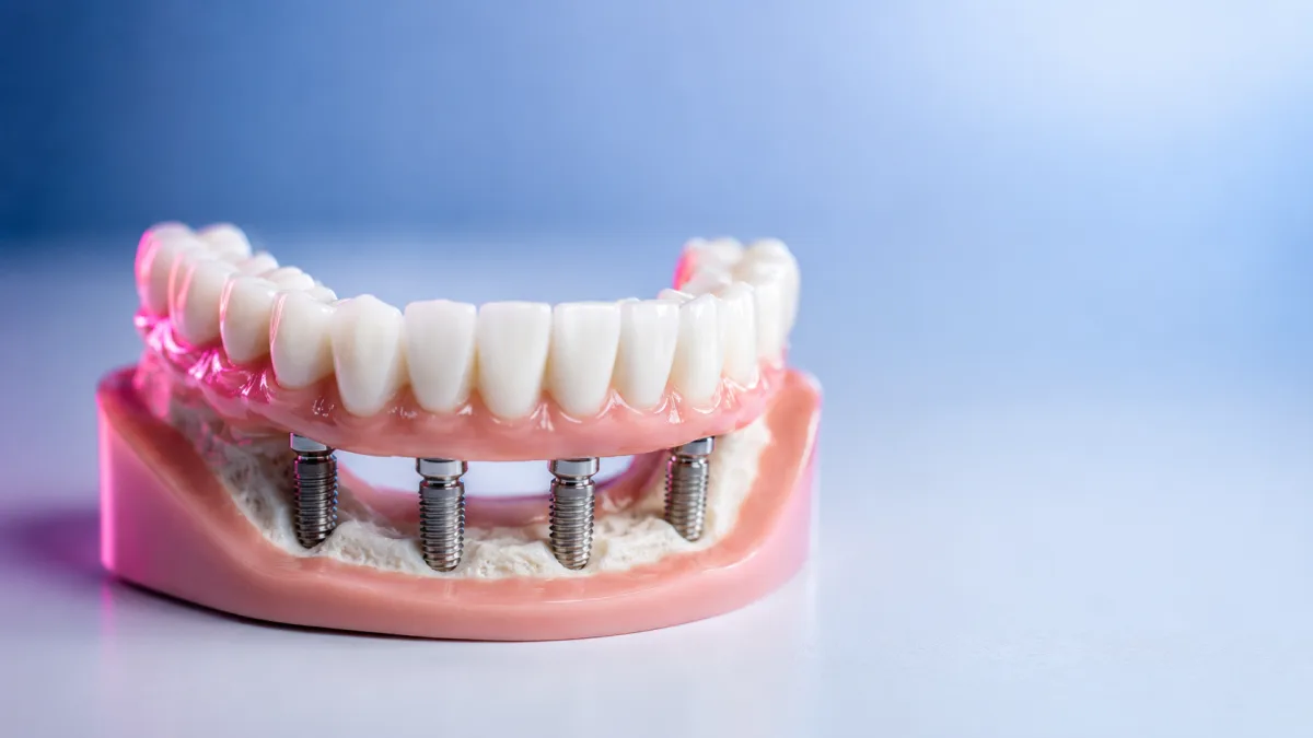 Имплантация при полном отсутствии зубов — несъёмный протез на имплантах, Dental Centre Красногорск