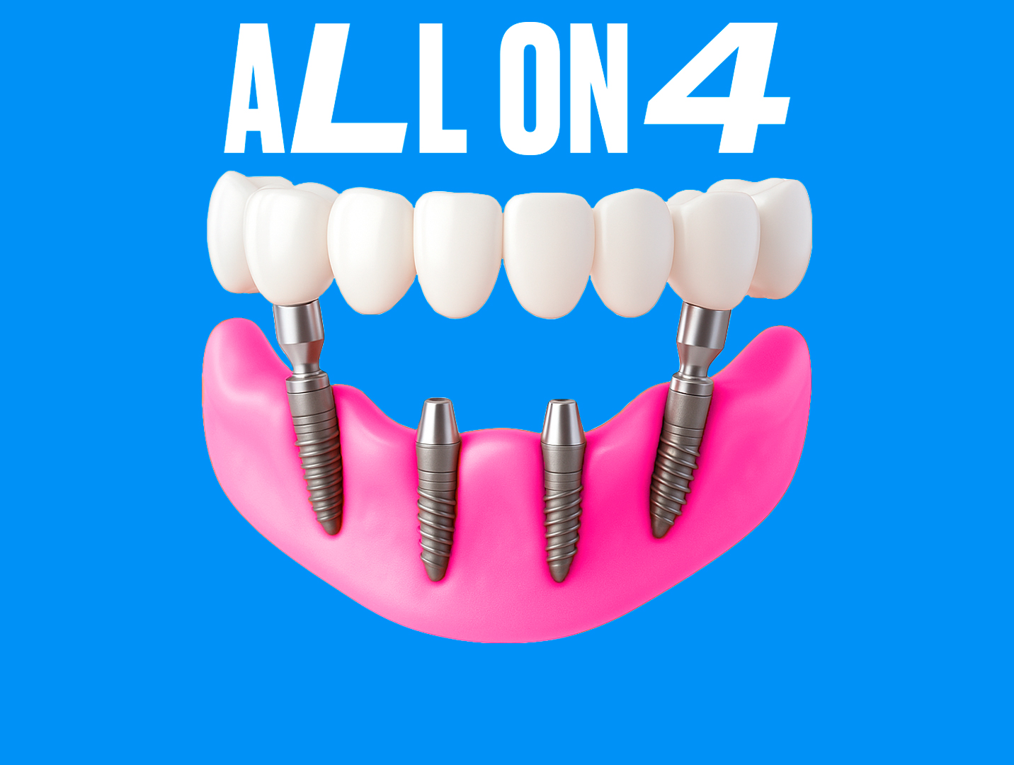 Имплантация зубов