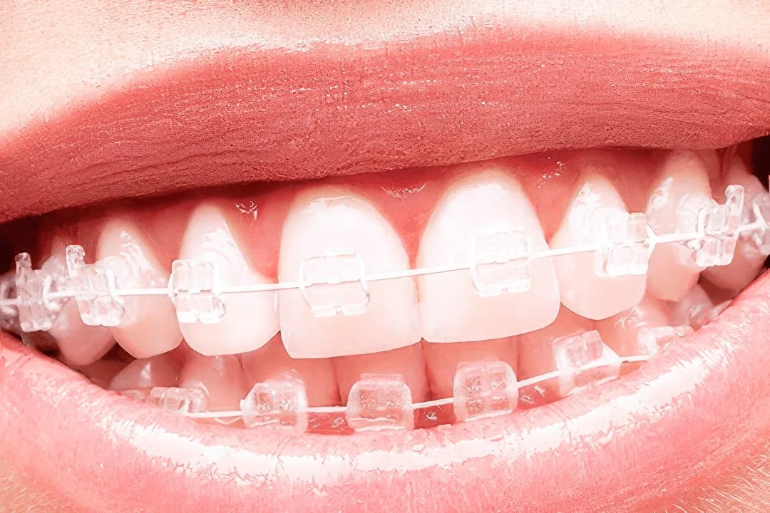 Керамические брекеты — эстетичное исправление прикуса в Dental Centre