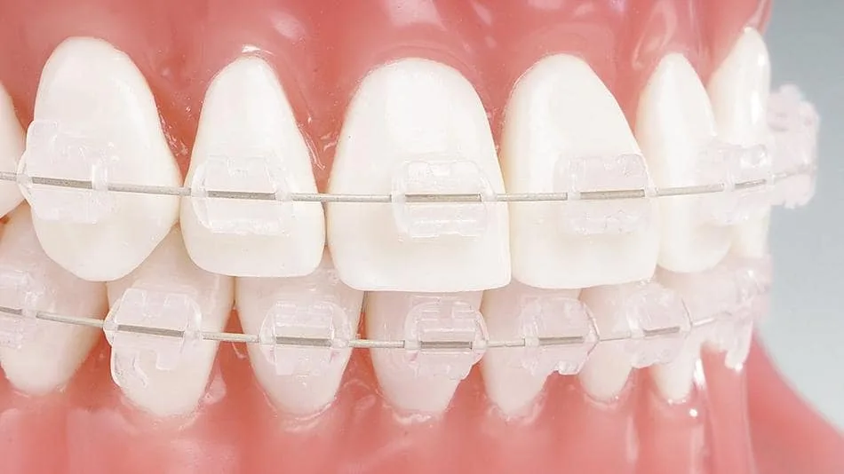 Результат исправления прикуса керамическими брекетами — Dental Centre