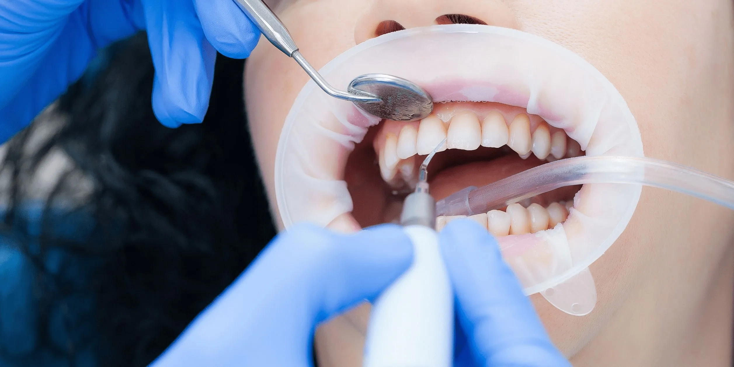 Ультразвуковая чистка зубов — профессиональная гигиена полости рта Dental Centre