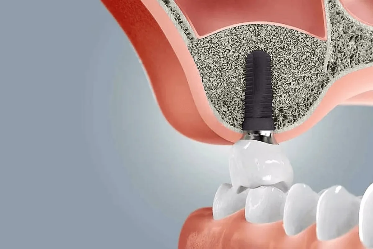 Костная пластика перед имплантацией зубов — наращивание кости в Dental Centre