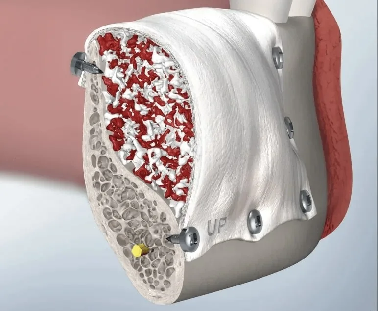 Имплантация All-on-4 — восстановление полного зубного ряда на имплантах