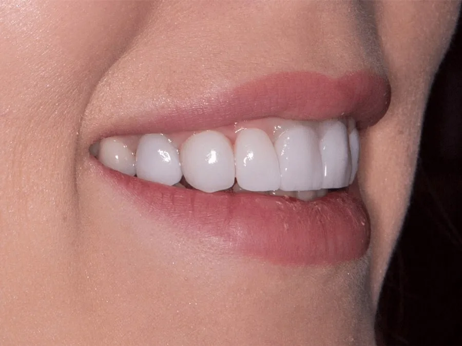 Щель между зубами (диастема) — как убрать