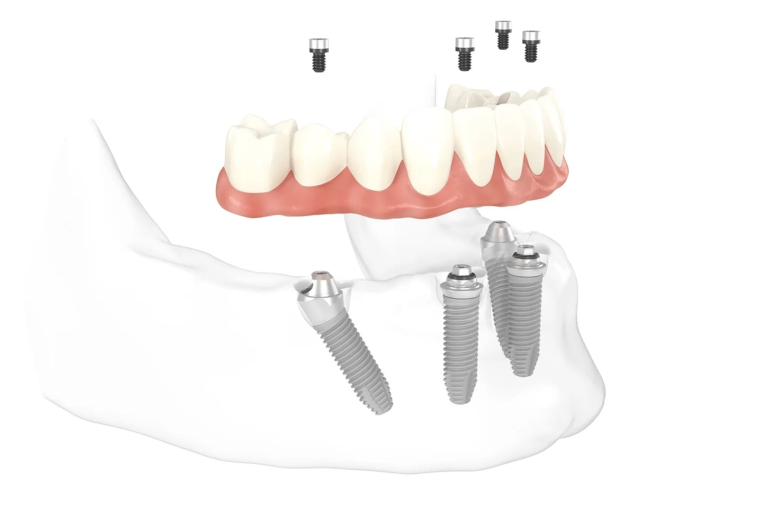 Протез All-On-4 — несъёмное протезирование на имплантах, Dental Centre