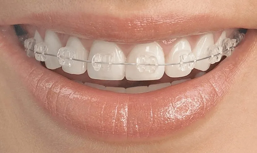 Сапфировые брекеты — исправление прикуса в Dental Centre Красногорск