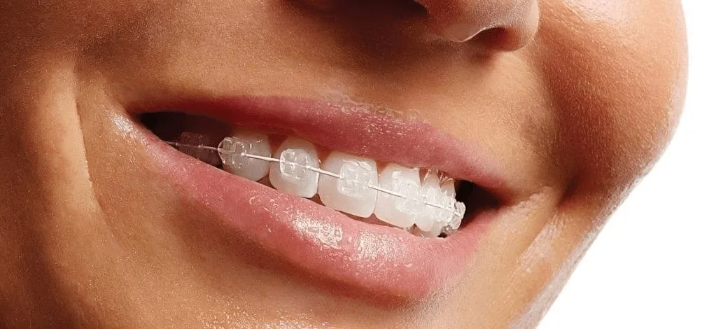 Результат исправления прикуса сапфировыми брекетами — Dental Centre