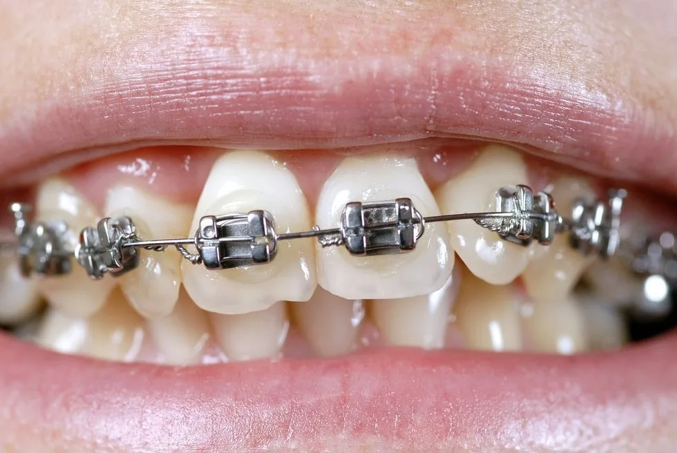 Результат ортодонтического лечения металлическими брекетами — Dental Centre